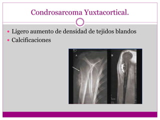 Condrosarcoma Yuxtacortical.
 Ligero aumento de densidad de tejidos blandos
 Calcificaciones
 