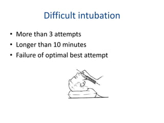 Difficult intubation
• More than 3 attempts
• Longer than 10 minutes
• Failure of optimal best attempt
 