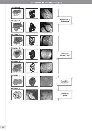 C o n d u c t a s e n G a s t r o e n t e r o l o g í a
238
Hiperplásico ó
Inflamatorio
Adenomas
con DBG ó DAG
Neoplásico
No Invasor
Neoplásico
Invasor
Pit Pattern I
Pit Pattern II
Pit Pattern III - L
Pit Pattern III - S
Pit Pattern IV
Pit Pattern V
Pit Pattern VI
        
 