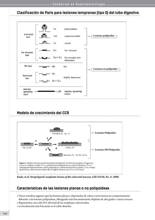 C o n d u c t a s e n G a s t r o e n t e r o l o g í a
242
Clasificación de Paris para lesiones tempranas (tipo 0) del tubo digestivo
Modelo de crecimiento del CCR
Kudo, et al. Nonpolypoid neoplastic lesions of the colorectal mucosa. GIE Vol 68, No. 4: 2008
Características de las lesiones planas o no polipoideas
• Varios estudios sugieren que las lesiones planas y deprimidas de colon y recto tienen un comportamiento
   diferente a las lesiones polipoideas, albergando más frecuentemente displasia de alto grado o cáncer invasor.
• Representan cerca del 25% del total de las neoplasias colorrectales.
• La localización más frecuente es el colon derecho.
 