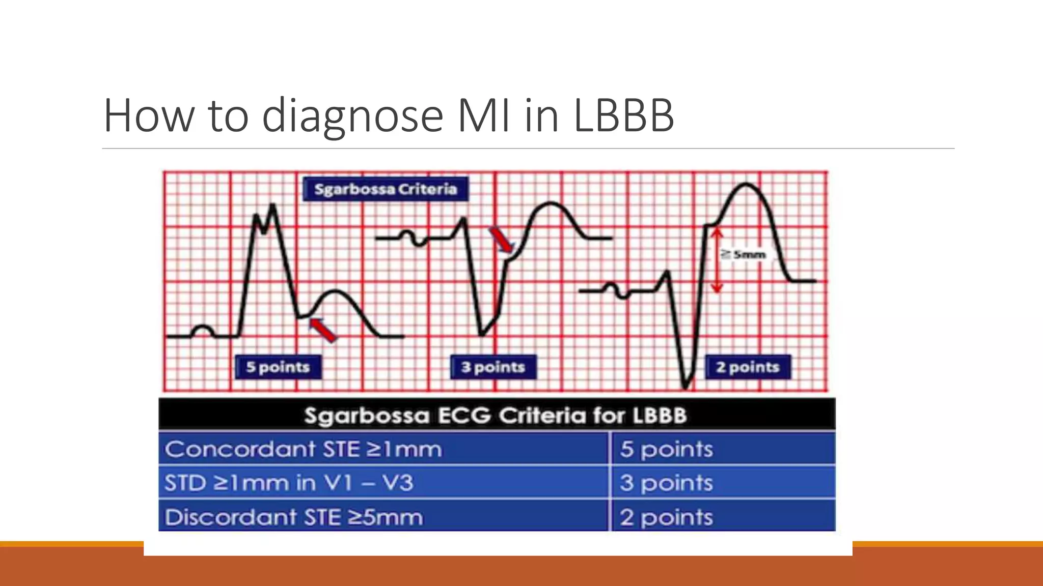 How to diagnose MI in LBBB
 