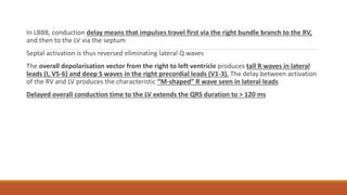 In LBBB, conduction delay means that impulses travel first via the right bundle branch to the RV,
and then to the LV via the septum
Septal activation is thus reversed eliminating lateral Q waves
The overall depolarisation vector from the right to left ventricle produces tall R waves in lateral
leads (I, V5-6) and deep S waves in the right precordial leads (V1-3). The delay between activation
of the RV and LV produces the characteristic “M-shaped” R wave seen in lateral leads
Delayed overall conduction time to the LV extends the QRS duration to > 120 ms
 