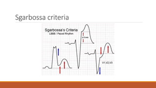 Sgarbossa criteria
 