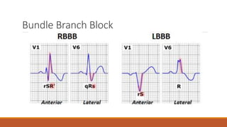 Bundle Branch Block
 