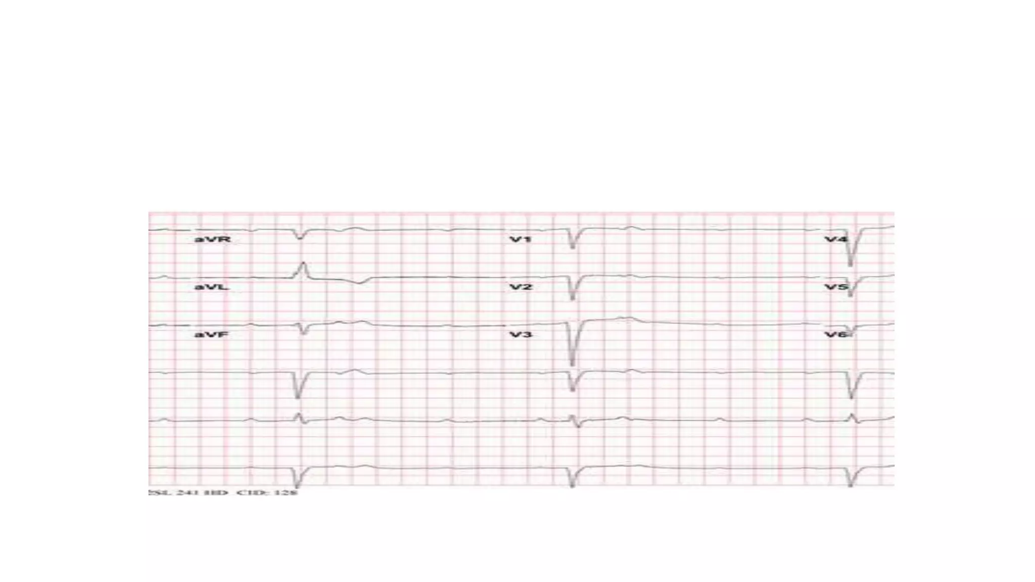 Conduction abnormalities part 2 | PPTX