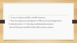Conduction abnormalities part 2 | PPTX