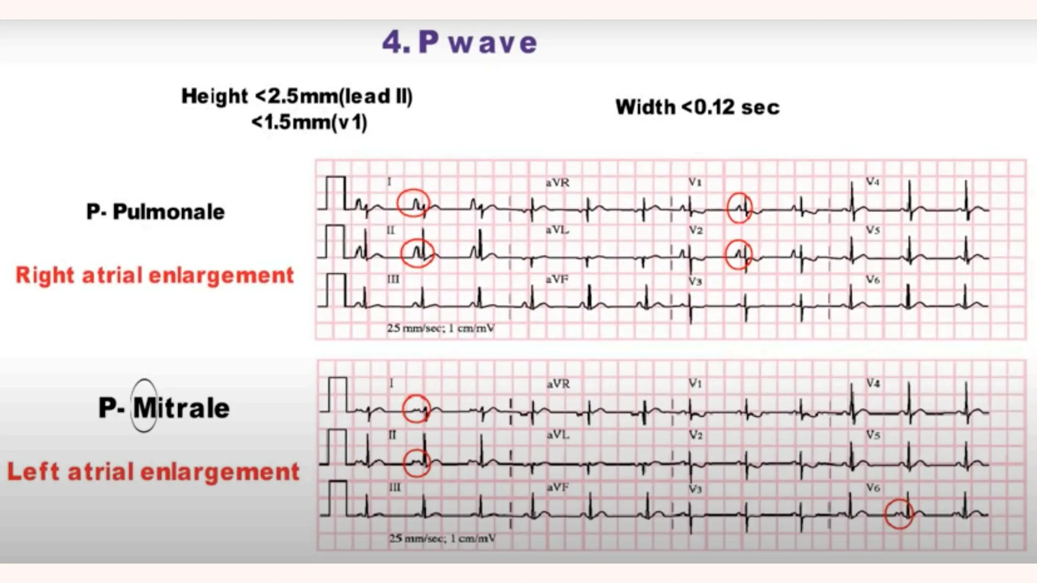 Conduction and its abnormalities .pdf