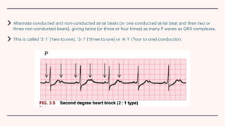 Conduction and its abnormalities .pdf
