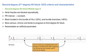 ECG - Conduction defects - Hoang Van Cuong HMU | PPT