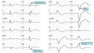 ECG - Conduction defects - Hoang Van Cuong HMU | PPTX