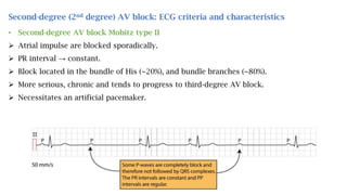 Second-degree (2nd degree) AV block: ECG criteria and characteristics
• Second-degree AV block Mobitz type II
 Atrial impulse are blocked sporadically.
 PR interval → constant.
 Block located in the bundle of His (~20%), and bundle branches (~80%).
 More serious, chronic and tends to progress to third-degree AV block.
 Necessitates an artificial pacemaker.
 
