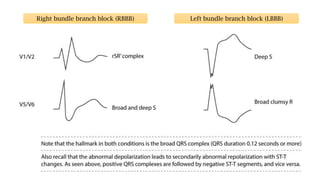 Right bundle branch block (RBBB) Left bundle branch block (LBBB)
 