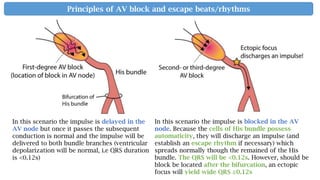 In this scenario the impulse is delayed in the
AV node but once it passes the subsequent
conduction is normal and the impulse will be
delivered to both bundle branches (ventricular
depolarization will be normal, i.e QRS duration
is <0.12s)
In this scenario the impulse is blocked in the AV
node. Because the cells of His bundle possess
automaticity, they will discharge an impulse (and
establish an escape rhythm if necessary) which
spreads normally though the remained of the His
bundle. The QRS will be <0.12s. However, should be
block be located after the bifurcation, an ectopic
focus will yield wide QRS ≥0.12s
Principles of AV block and escape beats/rhythms
 
