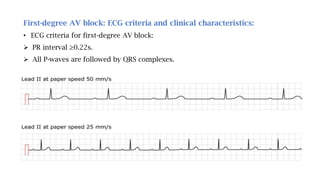 First-degree AV block: ECG criteria and clinical characteristics:
• ECG criteria for first-degree AV block:
 PR interval ≥0.22s.
 All P-waves are followed by QRS complexes.
 