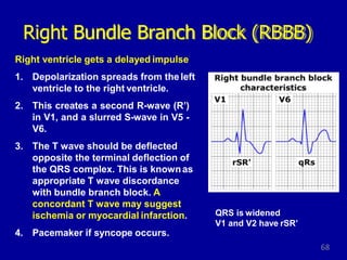 V1 Conduction Block Conduction disorders with sinoatrial blocks Dr Walinjom | PPTX