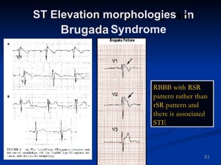 Conduction disorders with sinoatrial blocks Dr Walinjom | PPTX