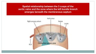 Conduction system abnormalities after transcatheter aortic valve ...