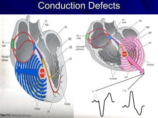 Conduction Defects

 