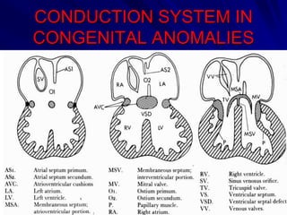 CONDUCTION SYSTEM IN
CONGENITAL ANOMALIES

 