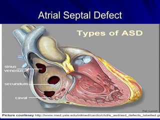 Atrial Septal Defect
There are 3 major types:
Secundum ASD – at the Fossa Ovalis, most
common.
• Primum ASD – lower in position & is a form of AVSD,
MV cleft.
• Sinus Venosus ASD – high in the atrial septum,
associated w/partial anomalous venous return & the
least common.

 