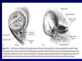 VSD
The perimembranous VSD is intimately
associated with the bundle of His which in
a d-loop heart passes through the tricuspid
annulus at the posterior and inferior corner
of the VSD.
The bundle soon branches into the right
and left bundle branch

 