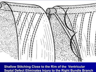 Shallow Stitching Close to the Rim of the Ventricular
Septal Defect Eliminates Injury to the Right Bundle Branch

 