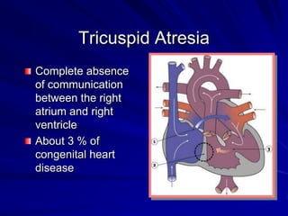 Tricuspid Atresia
Complete absence
of communication
between the right
atrium and right
ventricle
About 3 % of
congenital heart
disease

 