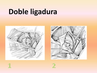 Doble ligadura