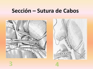 Sección – Sutura de Cabos