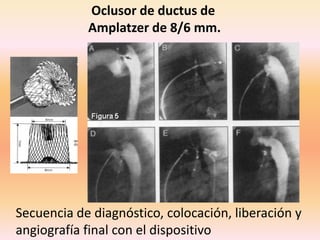 Oclusor de ductus de
Amplatzer de 8/6 mm.
Secuencia de diagnóstico, colocación, liberación y
angiografía final con el dispositivo