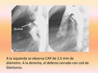 A la izquierda se observa CAP de 2,5 mm de
diámetro. A la derecha, el defecto cerrado con coil de
Gianturco.