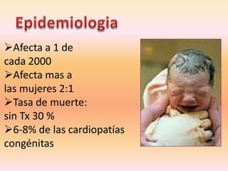 Afecta a 1 de
cada 2000
Afecta mas a
las mujeres 2:1
Tasa de muerte:
sin Tx 30 %
6-8% de las cardiopatías
congénitas