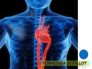 TETRALOGÍA DE FALLOT
 