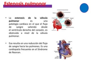 Estenosis pulmonar

• La estenosis de la válvula
  pulmonar             es          una
  patología cardíaca en el que el flujo
  de     sangre      saliendo    desde
  el ventrículo derecho del corazón, es
  obstruido a nivel de la válvula
  pulmonar.

• Eso resulta en una reducción del flujo
  de sangre hacia los pulmones. Es una
  cardiopatía frecuente en el Síndrome
  de Noonan.
 