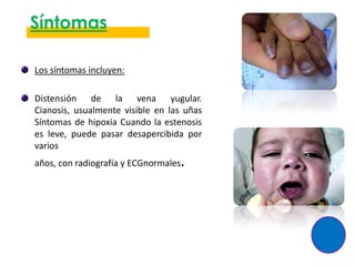 Síntomas

Los síntomas incluyen:

Distensión de la vena yugular.
Cianosis, usualmente visible en las uñas
Síntomas de hipoxia Cuando la estenosis
es leve, puede pasar desapercibida por
varios
años, con radiografía y ECGnormales.
 