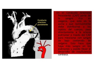 En el Conducto Arterioso
 Persistente (CAP) parte de
 la     sangre    rica   en
 oxígeno, que está en la
 aorta y que normalmente
 debe distribuirse a los
 tejidos del cuerpo, pasa
 directamente a la arteria
 pulmonar a través del CAP
 para mezclarse con sangre
 de bajo contenido de
 oxígeno. Esto hace que
 haya más sangre en los
 pulmones y puede llevar al
 desarrollo de insuficiencia
 cardiaca.
 