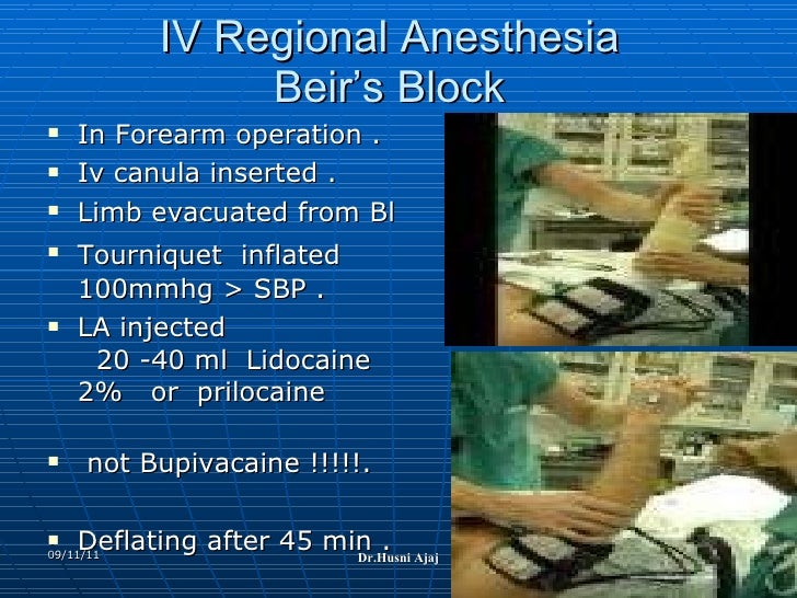 Conduct Of Local Anesthesia Technique And Complication