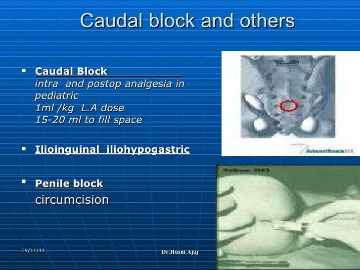 Conduct Of Local Anesthesia Technique And Complication
