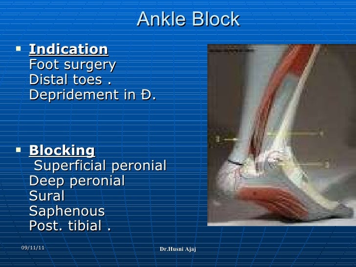 Conduct Of Local Anesthesia Technique And Complication