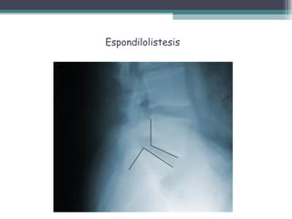 Espondilolistesis
 