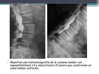 • Muestran una hidromielografía de la columna lumbar con
espondilolistesis L4 y discartrosis L5 severa que condicionan un
canal lumbar estrecho.
 