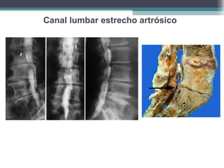 Discopatías con protrusiones discales y osteofitos
evidenciados por la Mielografía
Canal lumbar estrecho artrósico
 
