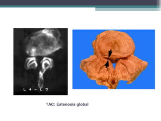 TAC: Estenosis global
 