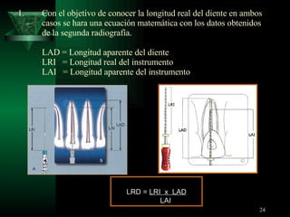 Con el objetivo de conocer la longitud real del diente en ambos casos se hara una ecuación matemática con los datos obtenidos de la segunda radiografía. LAD = Longitud aparente del diente LRI  = Longitud real del instrumento LAI  = Longitud aparente del instrumento LRD =  LRI  x  LAD LAI 