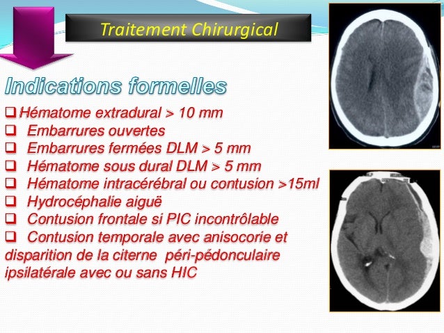 Conduite A Tenir Devant Un Traumatisme Cranien