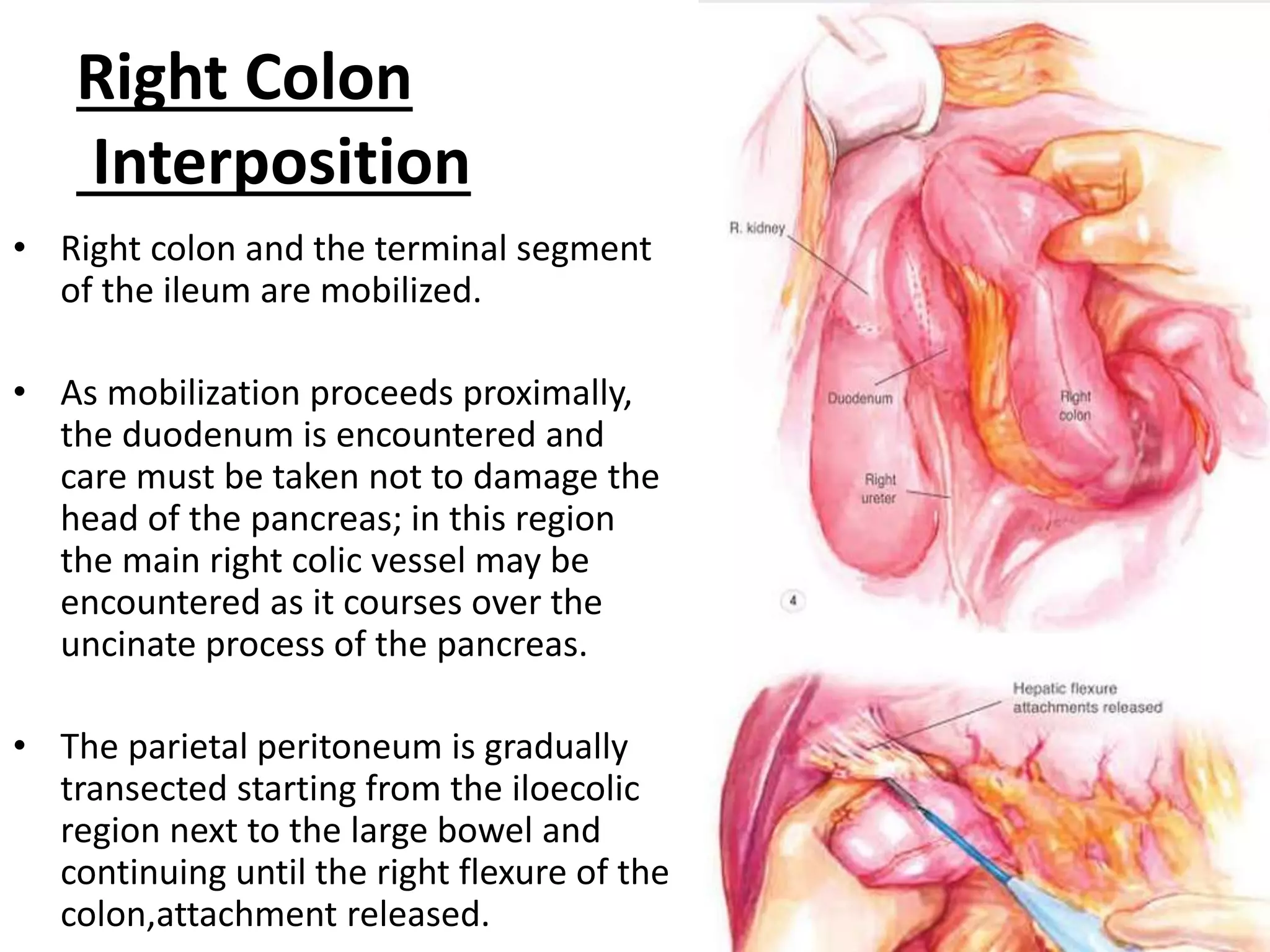 Conduits after esophagectomy for esophageal reconstruction | PPTX