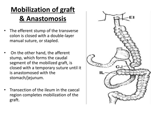 Conduits after esophagectomy for esophageal reconstruction | PPT