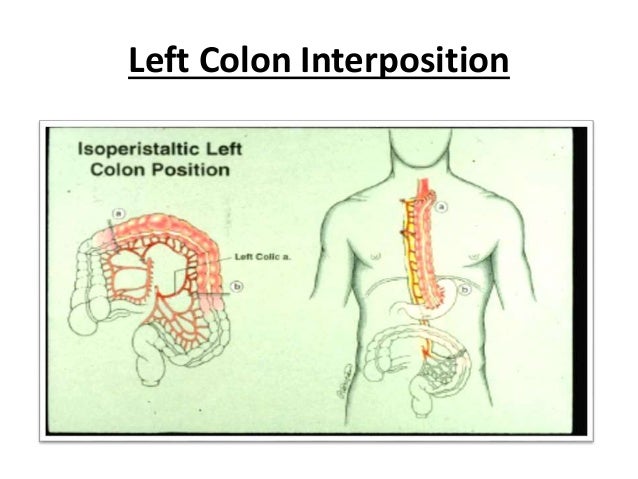 Conduits after esophagectomy for esophageal reconstruction