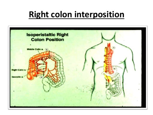 Conduits after esophagectomy for esophageal reconstruction diagram acid reflux 
