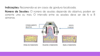 30
Indicações: Recomenda-se em casos de gordura localizada.
Número de Sessões: O número de sessões depende do objetivo, podem ser
somente uma ou mais. O intervalo entre as sessões deve ser de 6 a 8
semanas.
 